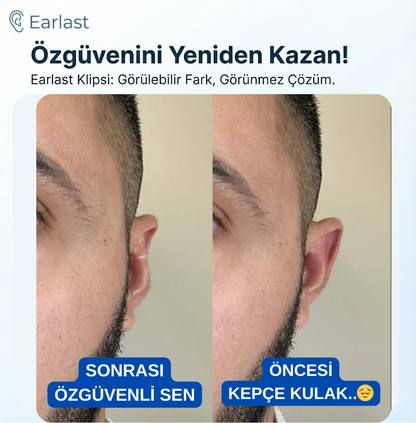 EarLast Clips ( 20 ADET )