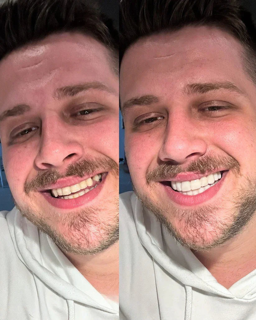 EARLAST LuxeSmile Biyouyumlu Yeni Nesil Takma Dişler