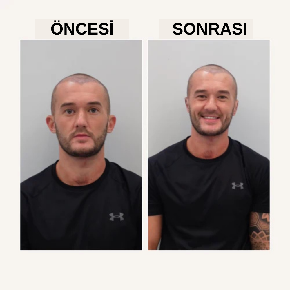 Earlast Kulak Düzeltici Piercing 2 Adet