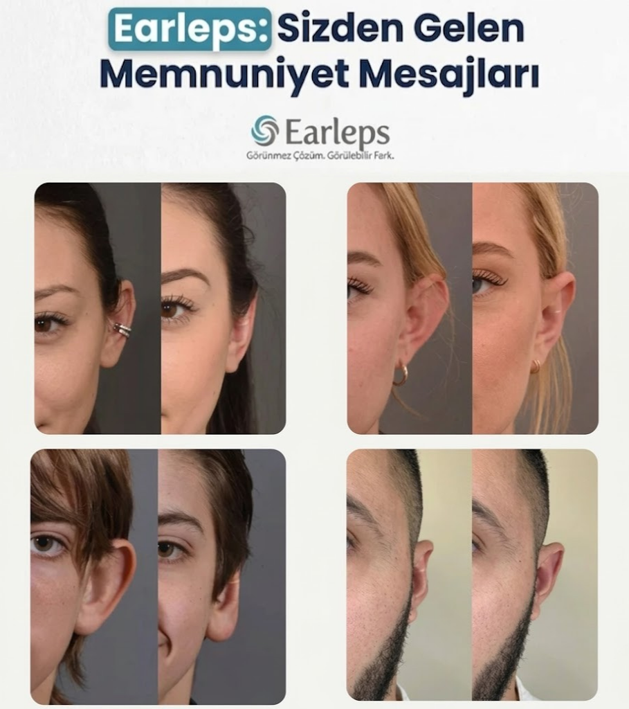 EarLeps Clips ( 20 ADET )